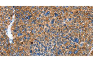 Immunohistochemistry of paraffin-embedded Human liver cancer using AUP1 Polyclonal Antibody at dilution of 1:50 (Ancient Ubiquitous Protein 1 antibody)