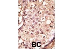 Formalin-fixed and paraffin-embedded human cancer tissue reacted with the primary antibody, which was peroxidase-conjugated to the secondary antibody, followed by AEC staining. (ACE2 antibody  (AA 140-172))