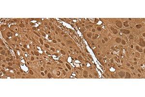 Immunohistochemistry of paraffin-embedded Human esophagus cancer tissue using VCP Polyclonal Antibody at dilution of 1:30(x200) (VCP antibody)