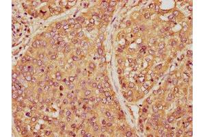 IHC image of ABIN7165036 diluted at 1:150 and staining in paraffin-embedded human liver cancer performed on a Leica BondTM system.