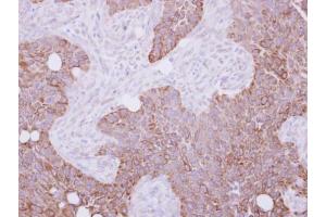 IHC-P Image Cytokeratin 15 antibody detects KRT15 protein at cytosol and membrane on HSC-3 xenograft by immunohistochemical analysis. (KRT15 antibody)