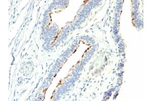 Formalin-fixed, paraffin-embedded human Colon Carcinoma stained with T-F Antigen / CD176 Mouse Monoclonal Antibody (A78-G/A7). (CD176 antibody)