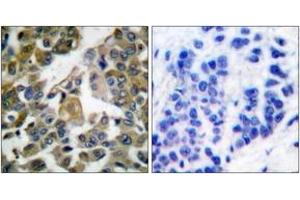 Immunohistochemistry analysis of paraffin-embedded human breast carcinoma tissue, using PLCG1 (Ab-783) Antibody.