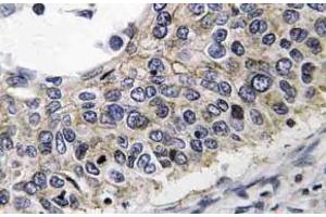 Immunohistochemistry (IHC) analyzes of PRX III antibody in paraffin-embedded human lung carcinoma tissue. (Peroxiredoxin 3 antibody)