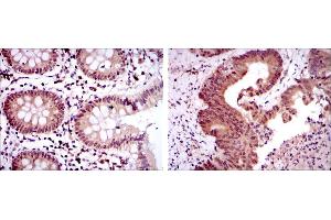 Immunohistochemical analysis of paraffin-embedded colon tissues (left) and colon cancer tissues (right) using OTX2 mouse mAb with DAB staining. (OTX2 antibody)