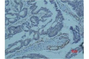 Immunohistochemical analysis of paraffin-embedded human colon caricnoma using Survivin Monoclonal Antibody. (Survivin antibody)