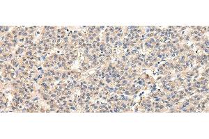 Immunohistochemistry of paraffin-embedded Human liver cancer tissue using VPS45 Polyclonal Antibody at dilution 1:50 (VPS45 antibody)