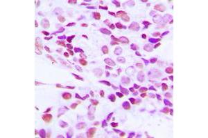 Immunohistochemical analysis of hnRNP G staining in human breast cancer formalin fixed paraffin embedded tissue section. (RBMX antibody  (N-Term))