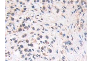 Detection of HLTF in Human Stomach cancer Tissue using Polyclonal Antibody to Helicase Like Transcription Factor (HLTF)