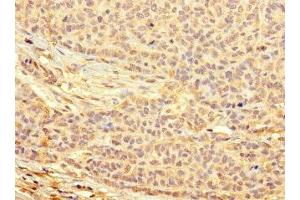Immunohistochemistry of paraffin-embedded human ovarian cancer using ABIN7166432 at dilution of 1:100 (METTL21C antibody  (AA 6-145))