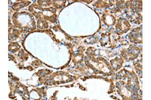 The image on the left is immunohistochemistry of paraffin-embedded Human thyroid cancer tissue using ABIN7189774(ALDH9A1 Antibody) at dilution 1/50, on the right is treated with synthetic peptide. (ALDH9A1 antibody)