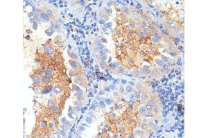 Immunohistochemistry of paraffin-embedded Human lung cancer using SEMA4C Polyclonal Antibody at dilution of 1:100 (40x lens). (SEMA4C antibody)