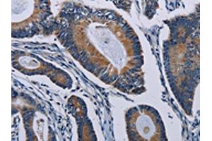 The image on the left is immunohistochemistry of paraffin-embedded Human colon cancer tissue using ABIN7191806(PCDHAC2 Antibody) at dilution 1/50, on the right is treated with synthetic peptide.