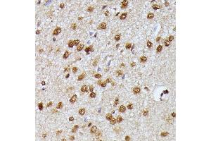 Immunohistochemistry of paraffin-embedded human esophageal cancer using KI Rabbit pAb (ABIN7269712) at dilution of 1:250 (40x lens). (Protein Virilizer Homolog (VIRMA) (AA 1400-1700) antibody)