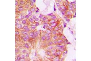 Immunohistochemical analysis of FHIT staining in human breast cancer formalin fixed paraffin embedded tissue section. (FHIT antibody  (Center))