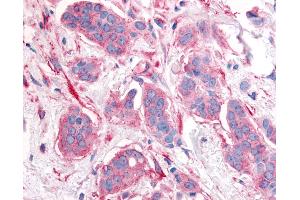 Anti-ERBB2 / HER2 antibody IHC of human breast carcinoma, neoplastic cells.