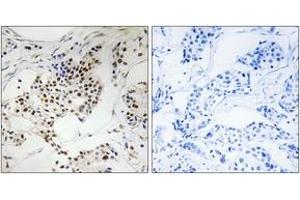 Immunohistochemistry analysis of paraffin-embedded human breast carcinoma, using SGOL2 Antibody. (SGOL2 antibody  (AA 681-730))