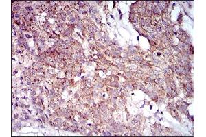 Immunohistochemical analysis of paraffin-embedded esophageal cancer tissues using MRPL42 mouse mAb with DAB staining. (MRPL42 antibody  (AA 142-203))