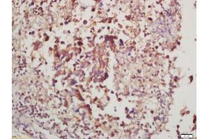 Formalin-fixed and paraffin embedded rat lung carcinoma labeled with Anti-phospho-P70 S6 Kinase beta (Thr228) Polyclonal Antibody, Unconjugated (ABIN732608) at 1:200, followed by conjugation to the secondary antibody and DAB staining
