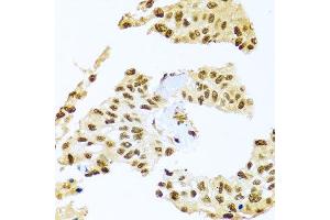 Immunohistochemistry of paraffin-embedded human lung cancer using SMEK1 antibody at dilution of 1:100 (x40 lens).