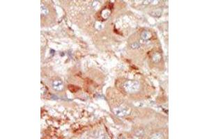 Formalin-fixed and paraffin-embedded human cancer tissue reacted with the primary antibody, which was peroxidase-conjugated to the secondary antibody, followed by DAB staining. (PRPF4B antibody  (C-Term))