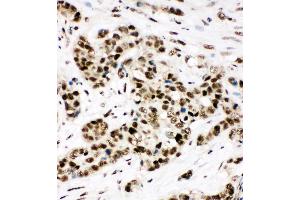 Anti-Ku80 antibody,  IHC(P) IHC(P): Human Lung Cancer Tissue Lysate (XRCC5 antibody  (C-Term))