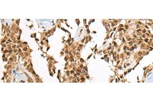 Immunohistochemistry of paraffin-embedded Human ovarian cancer tissue using ATE1 Polyclonal Antibody at dilution of 1:60(x200)