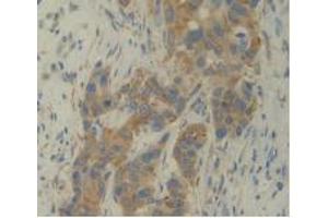IHC-P analysis of Human Breast Cancer Tissue, with DAB staining. (IL12A antibody  (AA 23-219))