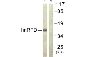 Immunohistochemistry analysis of paraffin-embedded human lung carcinoma tissue using hnRPD (Ab-83) antibody. (HNRNPD/AUF1 antibody  (Ser83))