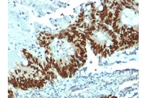 Formalin-fixed, paraffin-embedded human Colon Carcinoma stained with p53 Mouse Monoclonal Antibody (DO-1). (p53 antibody)