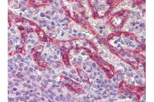 Immunohistochemistry (IHC) image for anti-Cadherin 1, Type 1, E-Cadherin (Epithelial) (CDH1) (AA 381-481) antibody (ABIN614587)