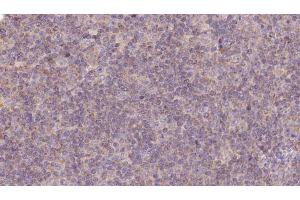 ABIN6273125 at 1/100 staining Human lymph cancer tissue by IHC-P. (HPS5 antibody  (Internal Region))