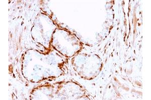 Formalin-fixed, paraffin-embedded human Prostate Tumor stained with AKR1B1 Mouse Monoclonal Antibody (CPTC-AKR1B1-3). (AKR1B1 antibody)