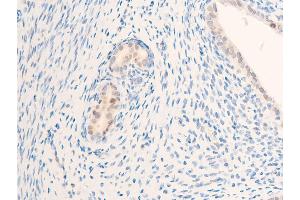 ABIN6267284 at 1/100 staining rat uterine cancer tissue sections by IHC-P. (ErbB2/Her2 antibody  (pTyr877))