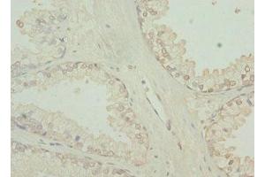 Immunohistochemistry of paraffin-embedded human prostate cancer using ABIN7173754 at dilution of 1:100 (TBCE antibody  (AA 328-527))
