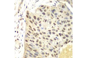 Immunohistochemistry of paraffin-embedded human lung cancer using FEN1 antibody at dilution of 1:100 (400x lens). (FEN1 antibody)