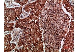 Immunohistochemical analysis of paraffin-embedded human-lung-cancer, antibody was diluted at 1:200 (IMP3 antibody  (AA 135-184))