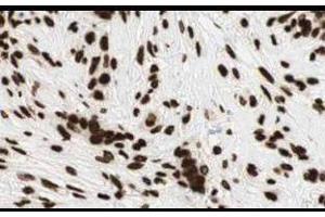 Affinity Purified anti-Gli2 antibody shows strong cytoplasmic and membranous staining of tumor cells in human breast tissue. (GLI2 antibody  (AA 30-65))