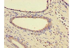 Immunohistochemistry of paraffin-embedded human prostate cancer using ABIN7170815 at dilution of 1:100 (HSPA9 antibody  (AA 458-679))