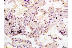 Formalin-fixed and paraffin embedded human lung carcinoma labeled with Rabbit Anti SDHC Polyclonal Antibody, Unconjugated (ABIN1385318) at 1:200 followed by conjugation to the secondary antibody and DAB staining