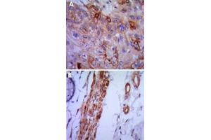 Immunohistochemical analysis of paraffin-embedded human lung cancer (A) and colon cancer (B) using VCAM1 monoclonal antobody, clone 6G9  with DAB staining.