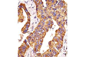 (ABIN390138 and ABIN2840642) staining P14 in human lung adenocarcinoma tissue sections by Iunohistochemistry (IHC-P - paraformaldehyde-fixed, paraffin-embedded sections). (MMP14 antibody  (N-Term))
