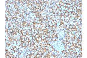 Formalin-fixed, paraffin-embedded human Melanoma stained with MCAM Mouse Monoclonal Antibody (MCAM/3048).