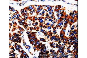 Immunohistochemistry of Human lung cancer using UTS2 Polyclonal Antibody at dilution of 1:50 (Urotensin 2 antibody)