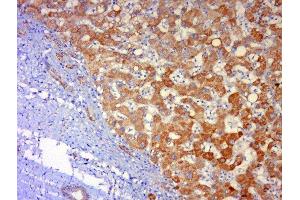 Paraformaldehyde-fixed, paraffin embedded human lung carcinoma, Antigen retrieval by boiling in sodium citrate buffer (pH6) for 15min, Block endogenous peroxidase by 3% hydrogen peroxide for 30 minutes, Blocking buffer (normal goat serum) at 37°C for 20min, Antibody incubation with 	JNK1 + 3 Polyclonal Antibody, Unconjugated  at 1:500 overnight at 4°C, followed by a conjugated secondary and DAB staining. (JNK antibody  (AA 201-300))