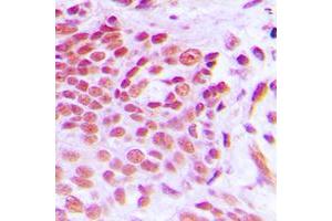 Immunohistochemical analysis of NAB2 staining in human breast cancer formalin fixed paraffin embedded tissue section. (NAB2 antibody  (Center))