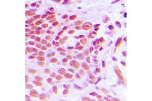 Immunohistochemical analysis of NAB2 staining in human breast cancer formalin fixed paraffin embedded tissue section.