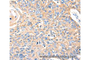 Immunohistochemistry of Human esophagus cancer using MVP Polyclonal Antibody at dilution of 1:30