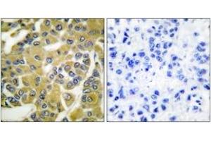 Immunohistochemistry analysis of paraffin-embedded human breast carcinoma, using IKK-beta (Phospho-Tyr188) Antibody.