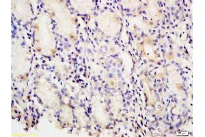 Formalin-fixed and paraffin embedded human gastric carcinoma tissue labeled with Anti-PAF Polyclonal Antibody, Unconjugated at 1:200 followed by conjugation to the secondary antibody and DAB staining (KIAA0101 antibody)